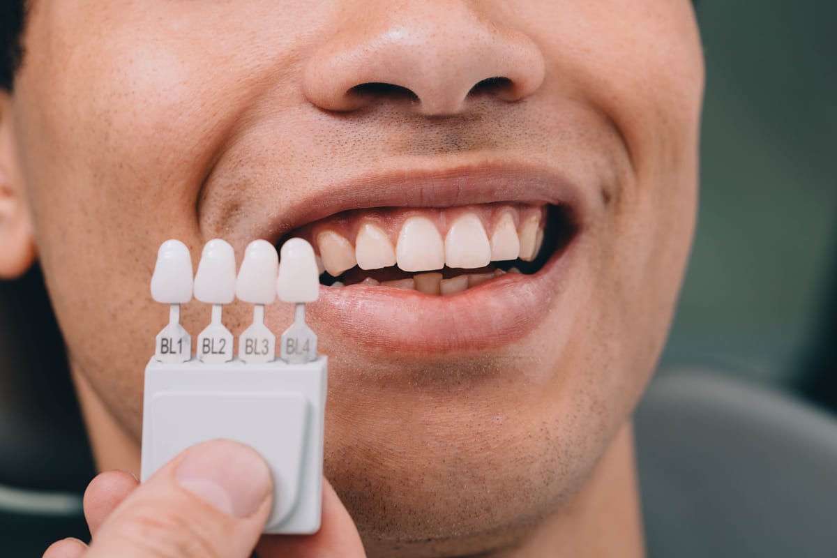 Veneers in Oklahoma City